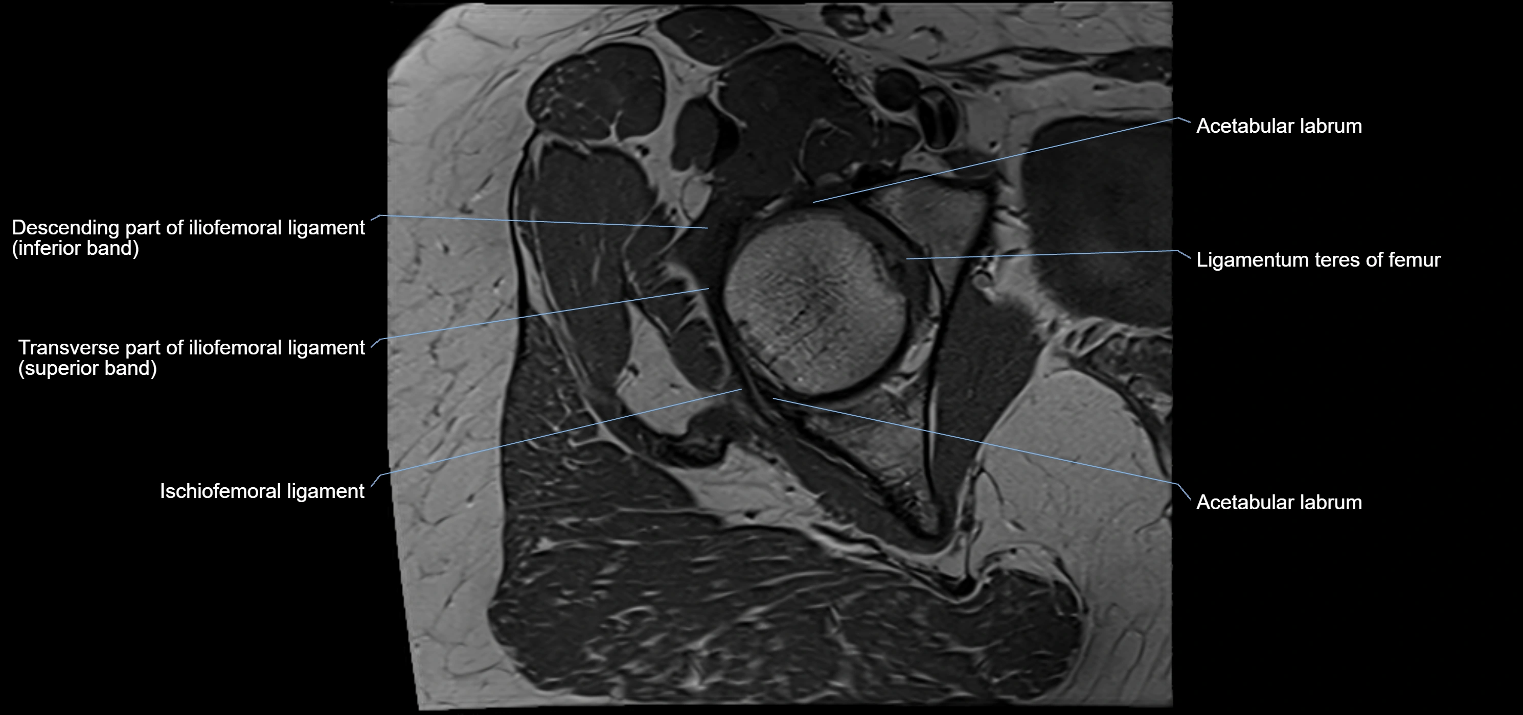 Hip ligament anatomy axial 3T MRI image -img-13001-00014.webp